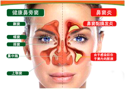 分清鼻窦炎类型 对症治疗才能药到病除